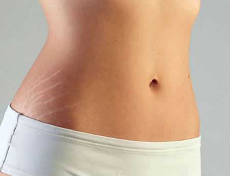 تخلص من علامات التمدد