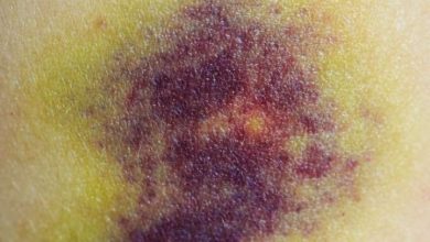 These problems lead to blue marks on the skin