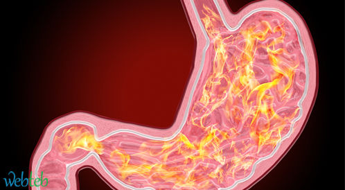 Watch the video: the causes of heartburn