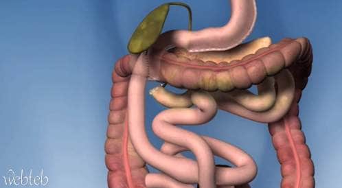 Stomach gag process and transformation of the bowel path