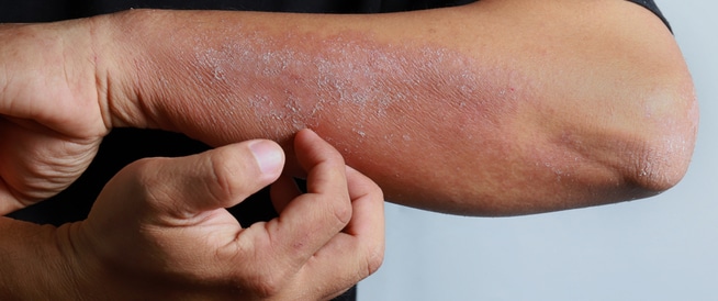 Dermatitis: Causes, Symptoms and Treatment