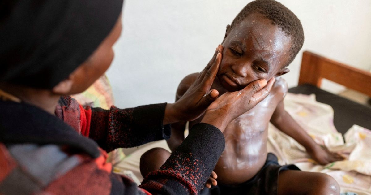 World Health Organization: 30.000 suspected monkey work in Africa