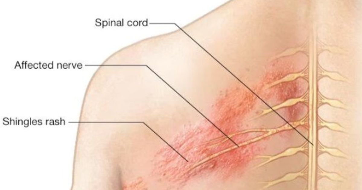 The fiery belt .. What is the herpes virus?