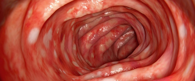 Colon inflammation: symptoms, causes and treatment