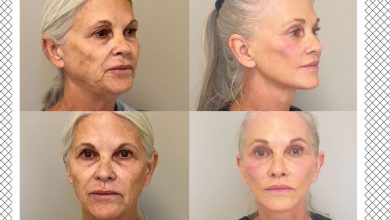 The Omakase FaceliFe that Changed This 66-YEAR-Old’s Face – ryan