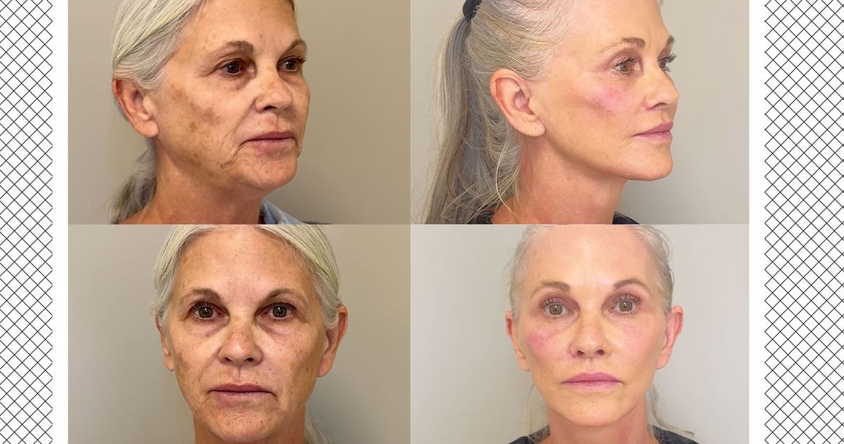 The Omakase FaceliFe that Changed This 66-YEAR-Old’s Face – ryan