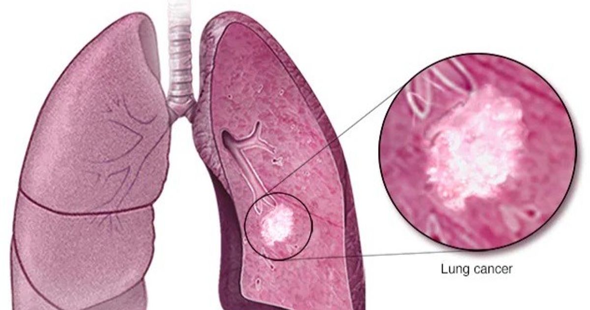 Study: Industrial sweeteners weaken the response to the treatment of lung cancer