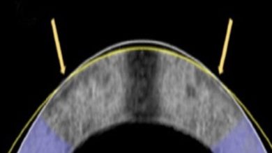 An alternative to Lasik operations .. correct vision with electrical current