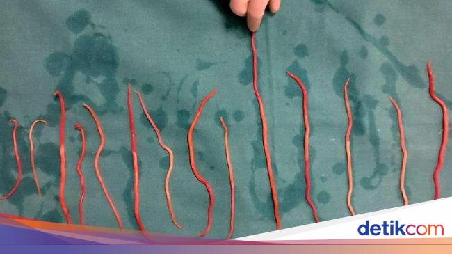 Toddler Sukabumi died with a body full of worms, RSUD said his condition