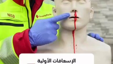 الإسعافات الأولية لوقف نزيف الأنف
